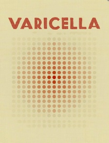 Varicella