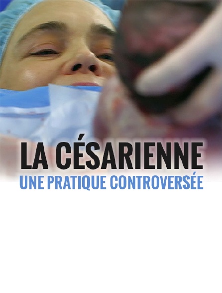 La césarienne : une pratique controversée