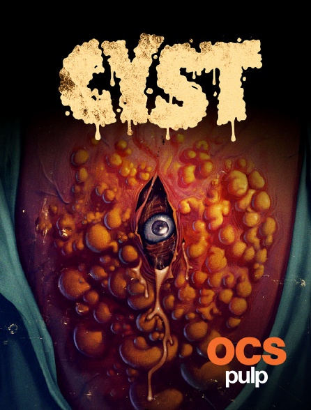 OCS Pulp - Cyst