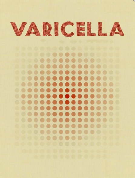 Varicella